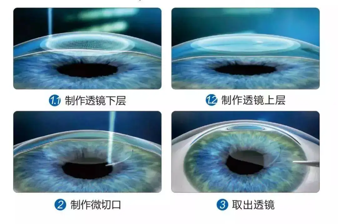 全飞秒近视手术过程