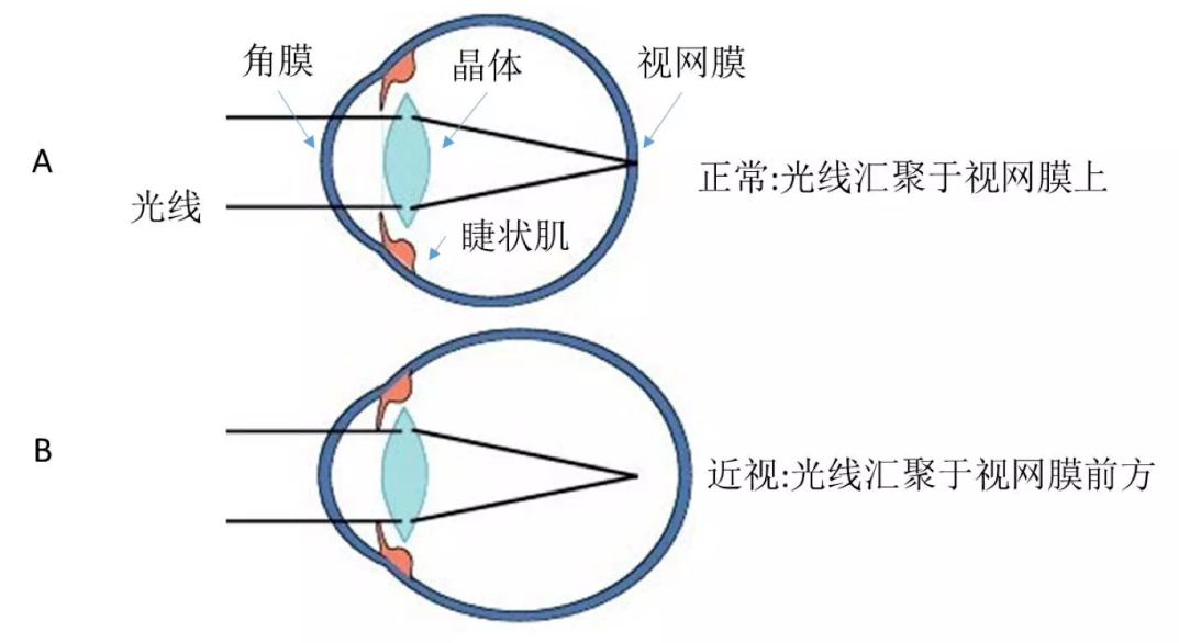 近视手术能“治愈”近视吗？