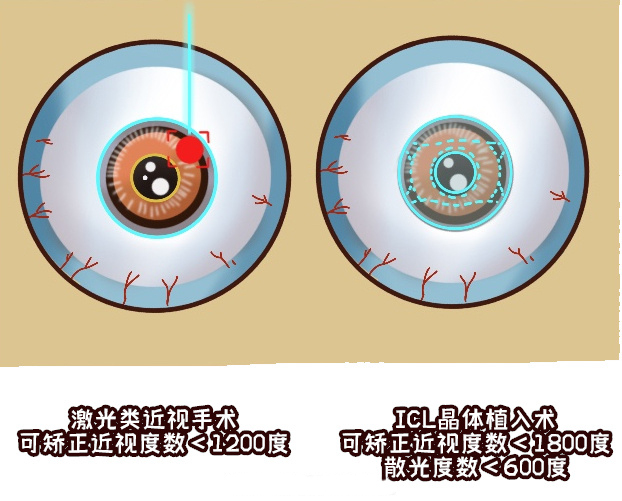 ICL 晶体植入术后需要注意哪些事项？