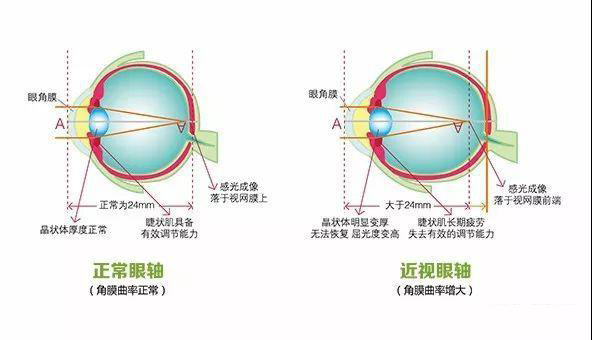 眼轴增长，近视度数一定增长吗？