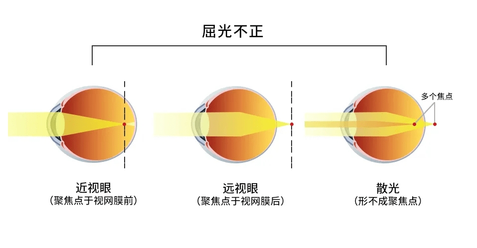 屈光不正的矫正方法有哪些?