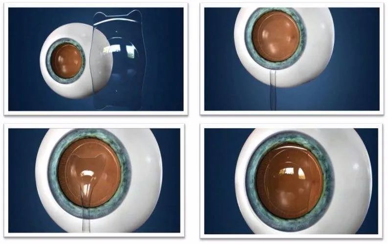 ICL植入的人工晶体能用多久？