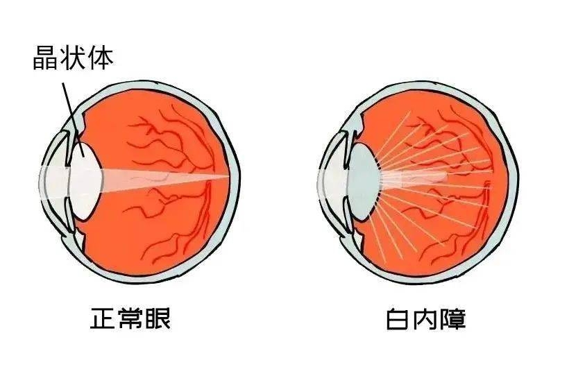 人为什么会得白内障?